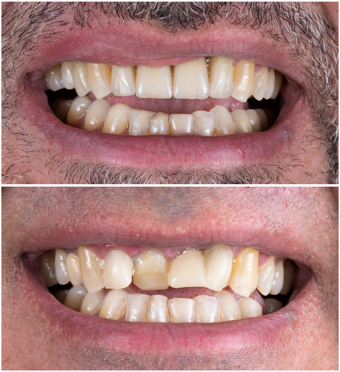 before and after picture for frontal teeth dental tratment by ceramic bridge