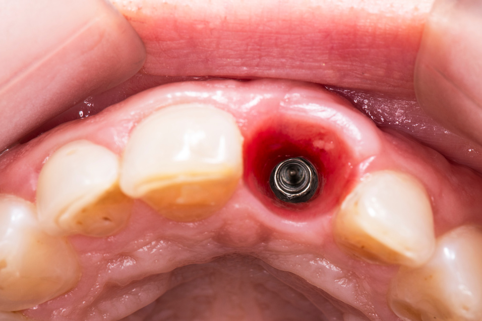 dental implant profile close up capture , focuse on implant