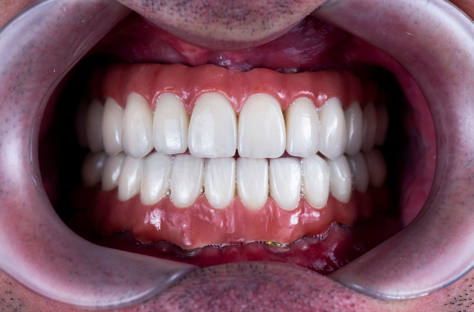 zirkon ceramic bridge on implants