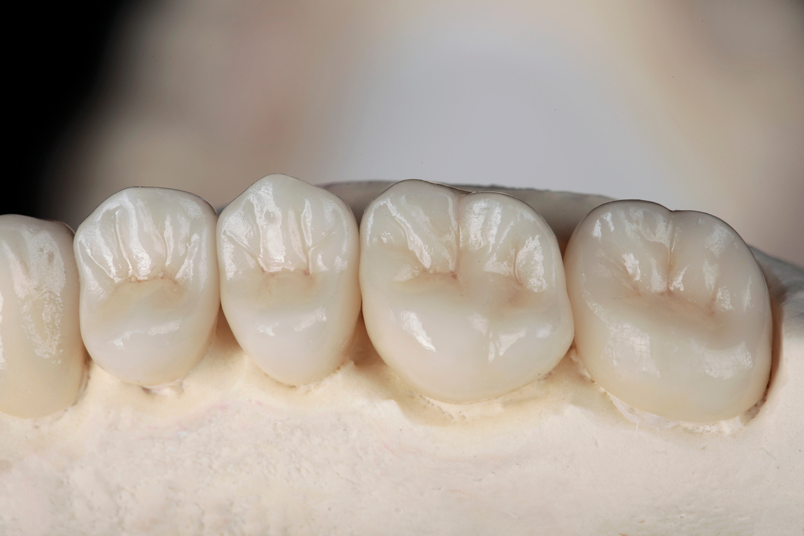 High Quality Ceramic Dental Crowns, Gum of the Jaw