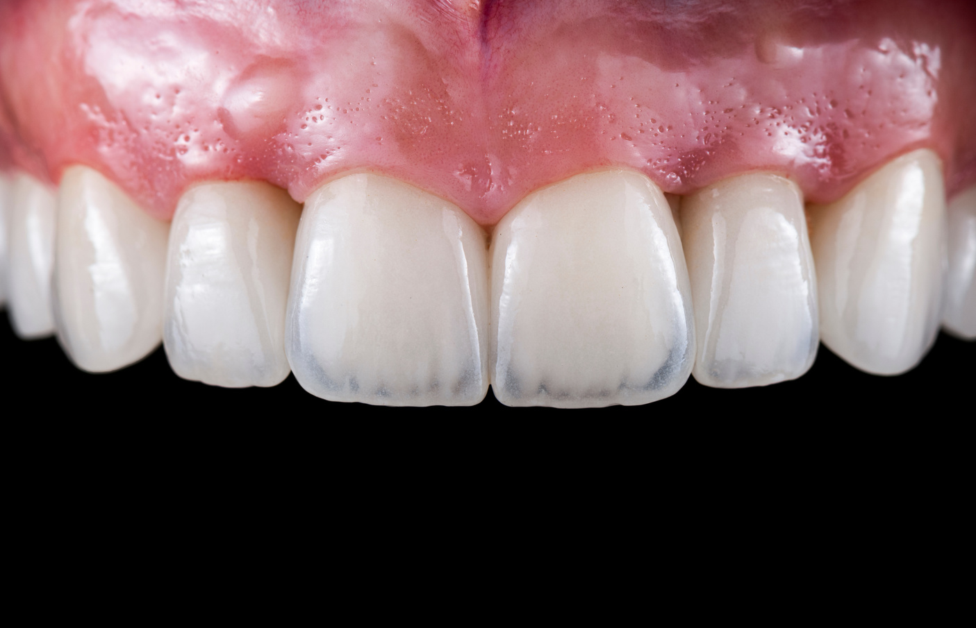 ceramic crowns and veneers b3 color