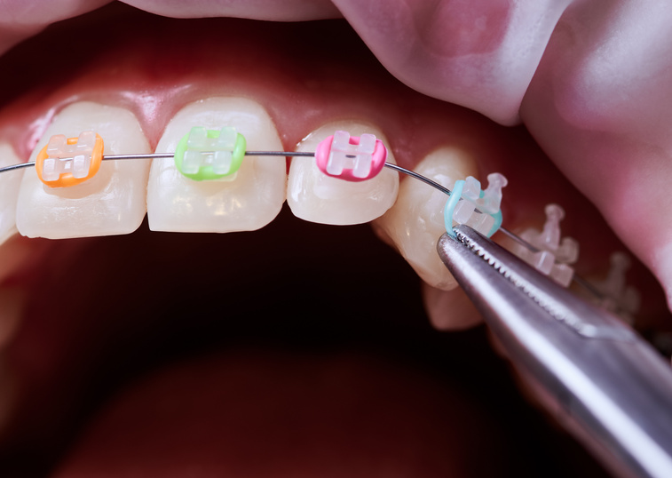 Dental procedure, process of removing colorful rubber bands from ceramic brackets