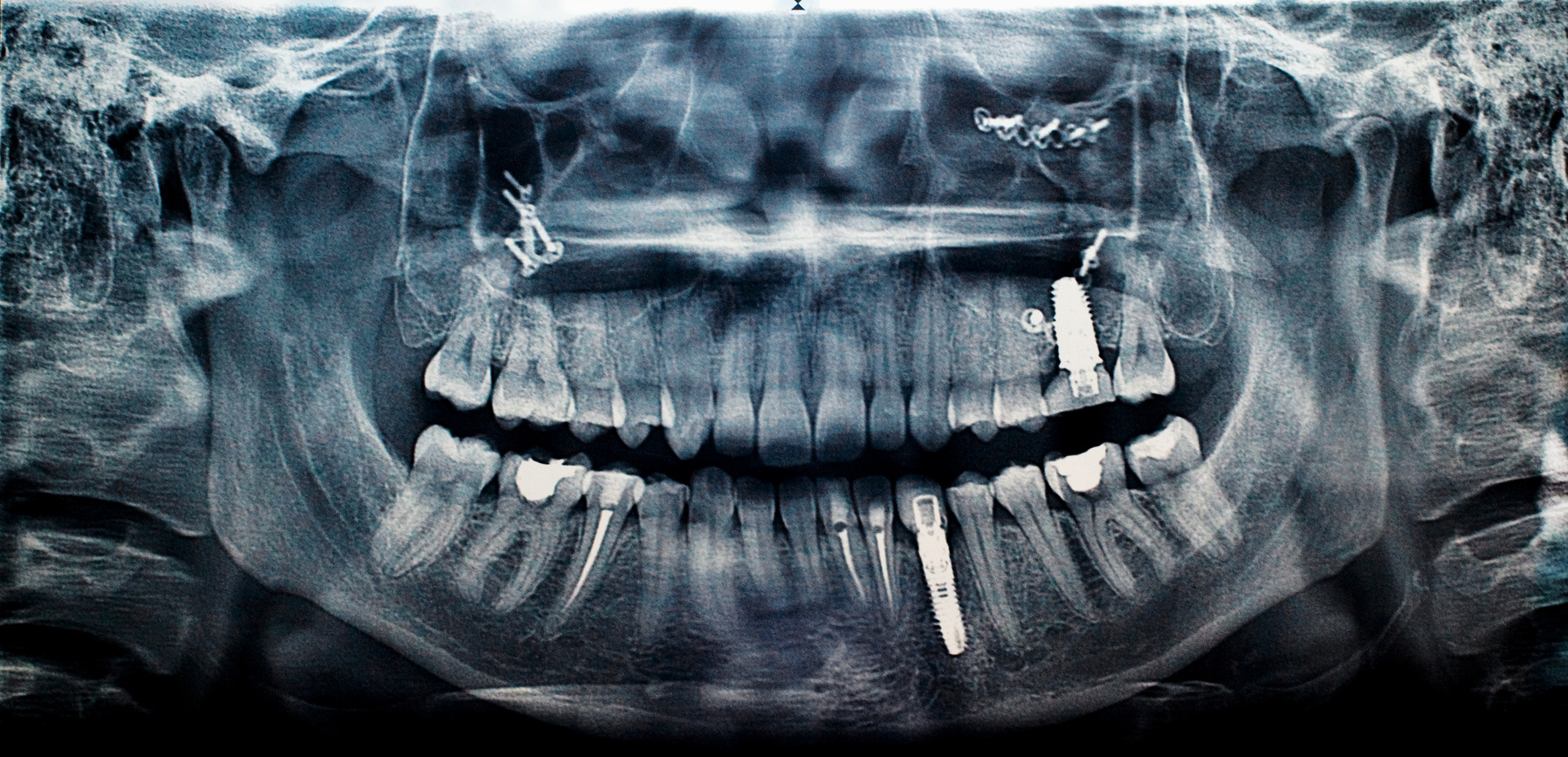 Implant