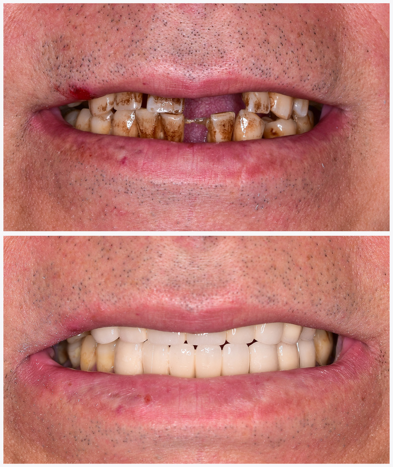 implant treatment before and after picture