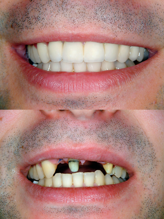 Before & After Smile Design