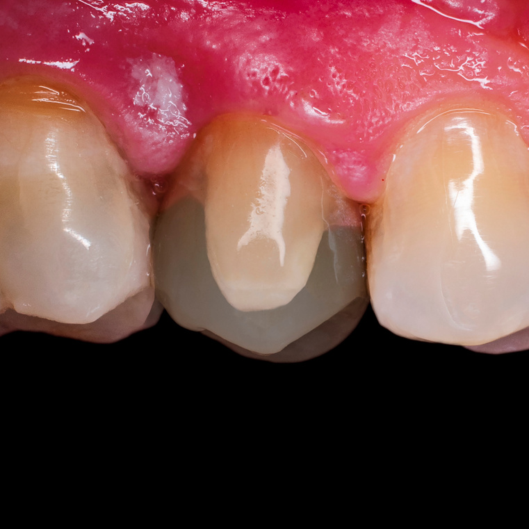 before and after in one picture of preped tooth , and the final with emax crown